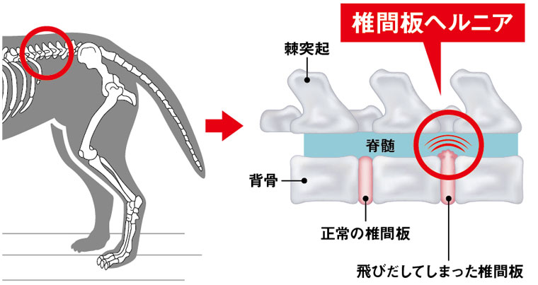 椎間板ヘルニア